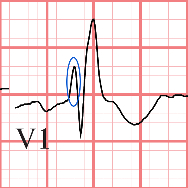 RBBB ECG