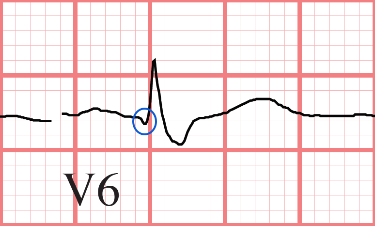 RBBB ECG