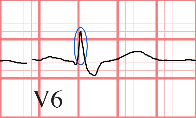 RBBB ECG