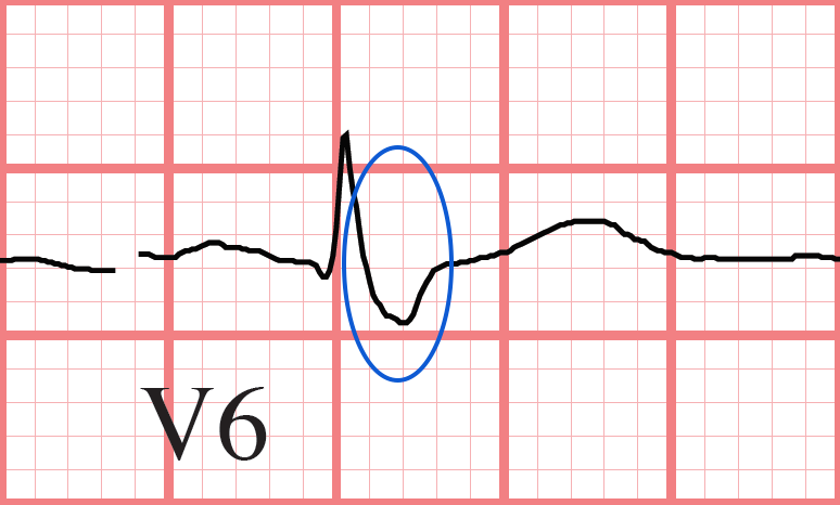 RBBB ECG