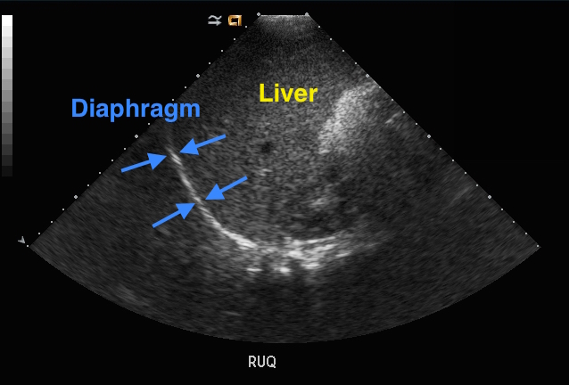 diaphragm seen on ultrasound