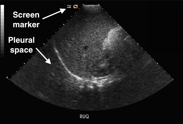 pleural space on ultrasound
