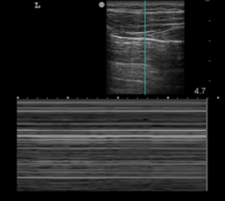 barcode sign on ultrasound