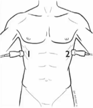 probe placement for lung ultrasound