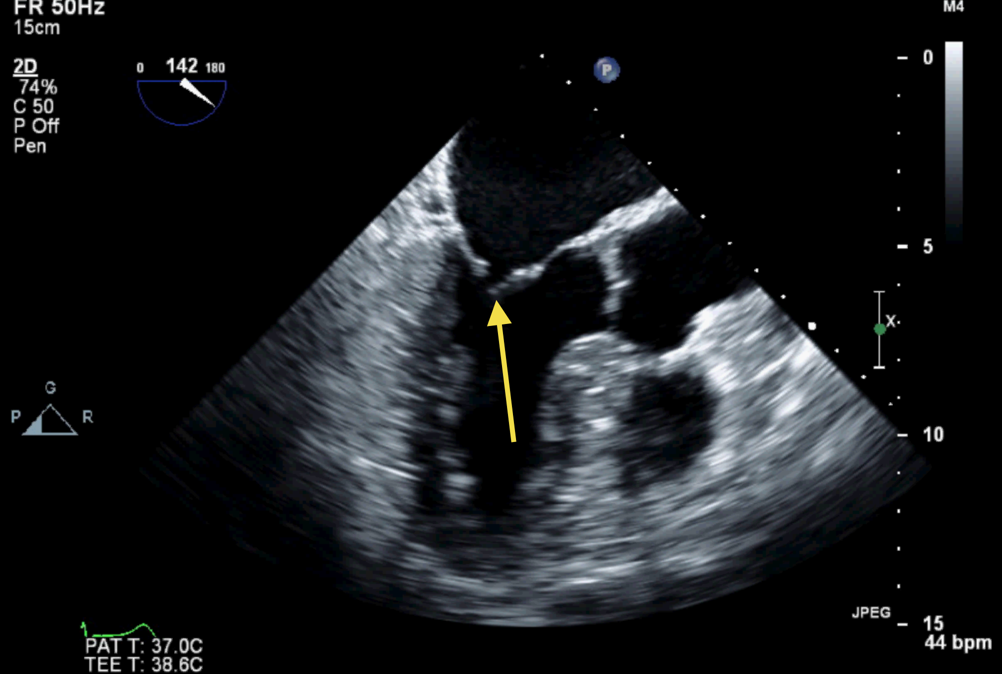 Practice TEE Normal Anatomy