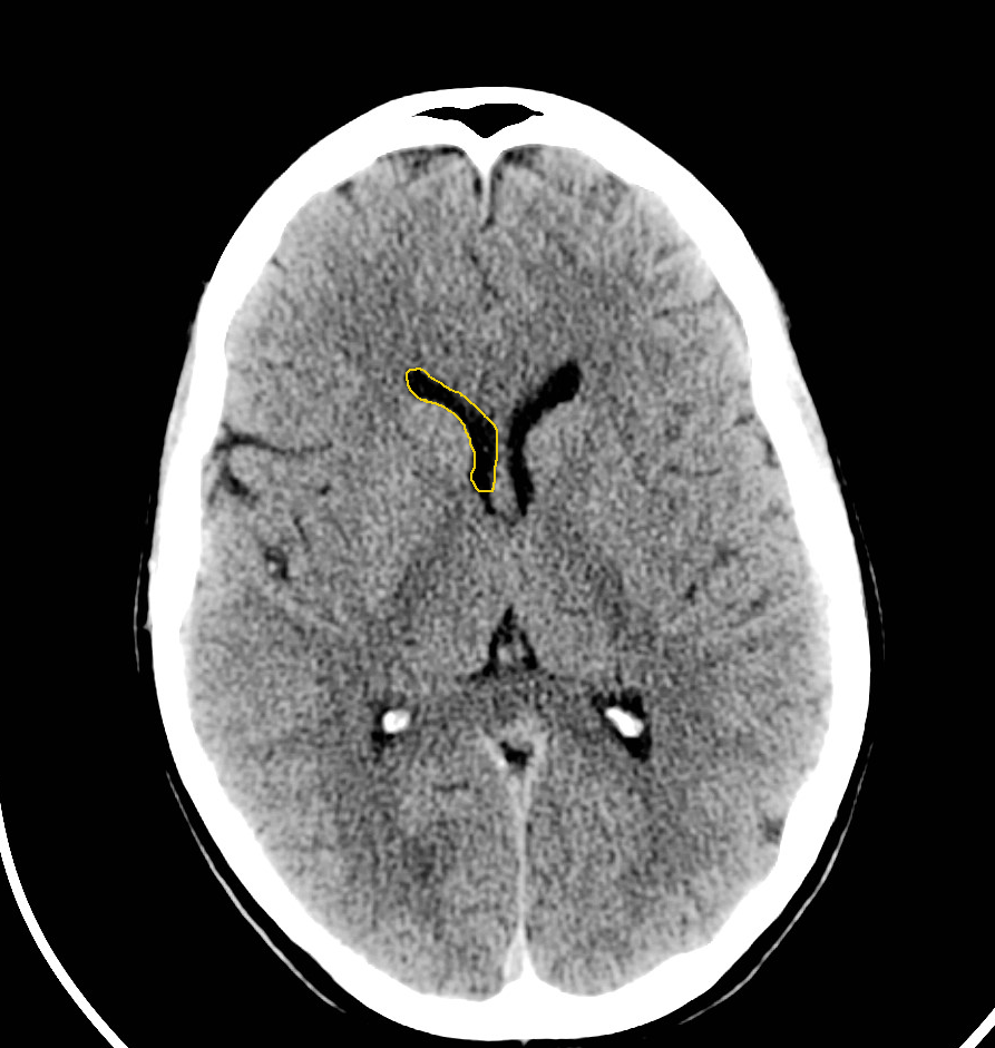 CT Head Normal Anatomy