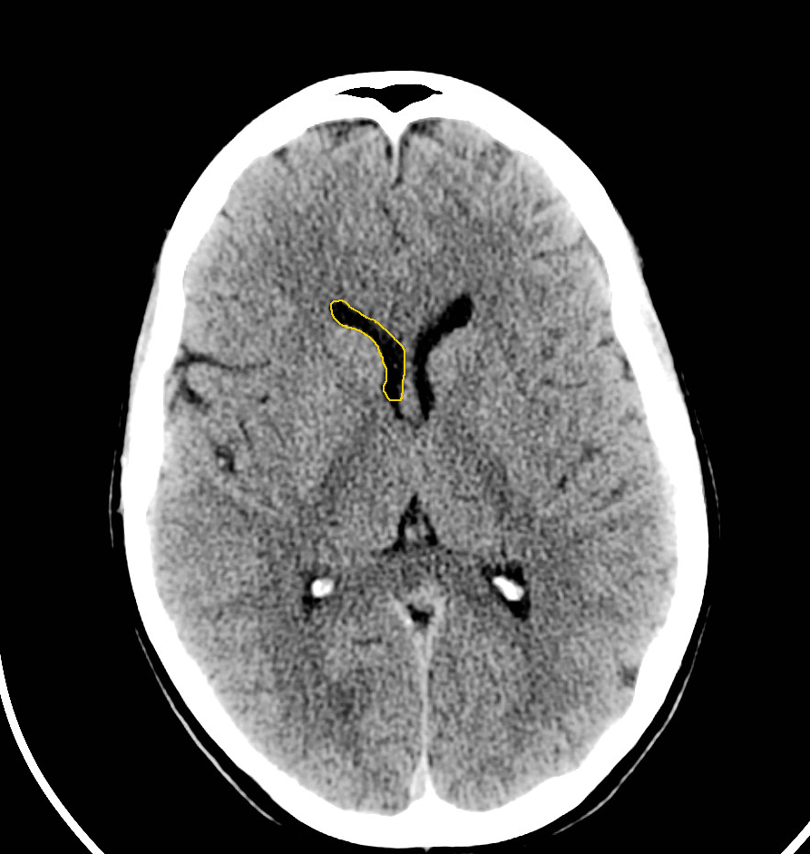 Ct Scan Brain Anatomy