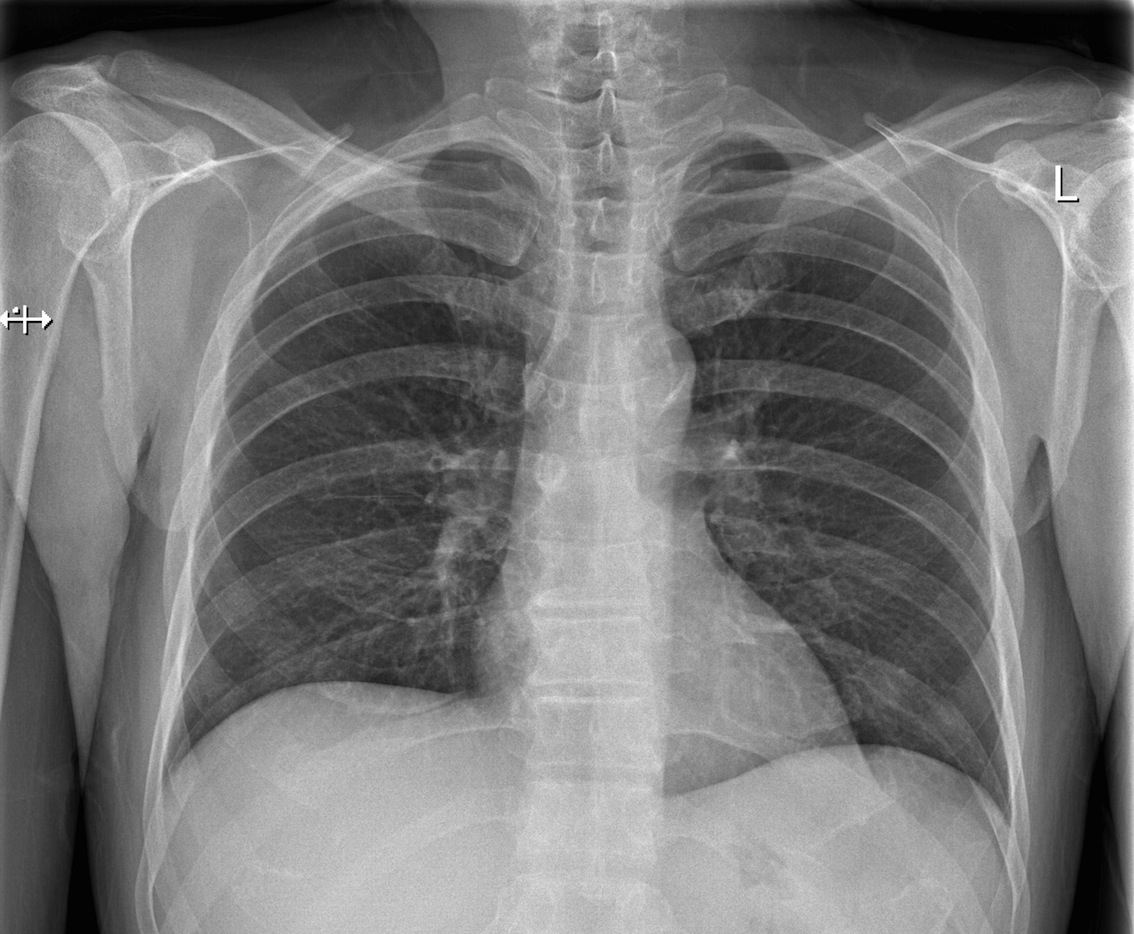 Practice Chest XRay Interpretation