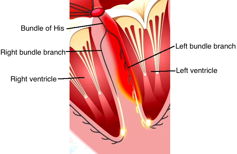 Septal depolarization