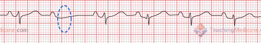 one missing QRS complex