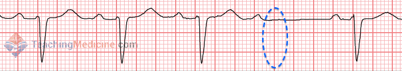 one missing QRS complex