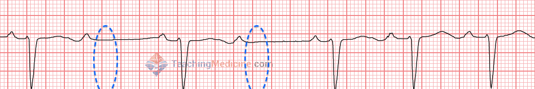 2 missing QRS complexes