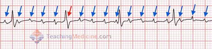 regular P waves