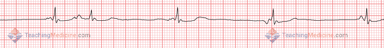 P wave shape and size