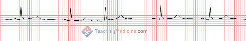 P wave shape and size