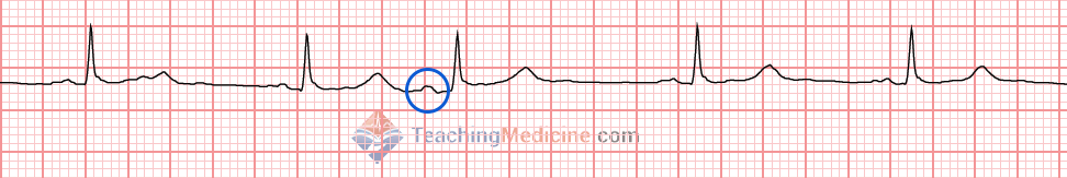 P wave shape and size