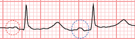 P wave shape and size