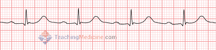 long PR interval