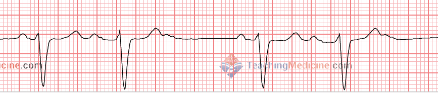 changing PR interval