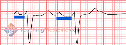 changing PR interval