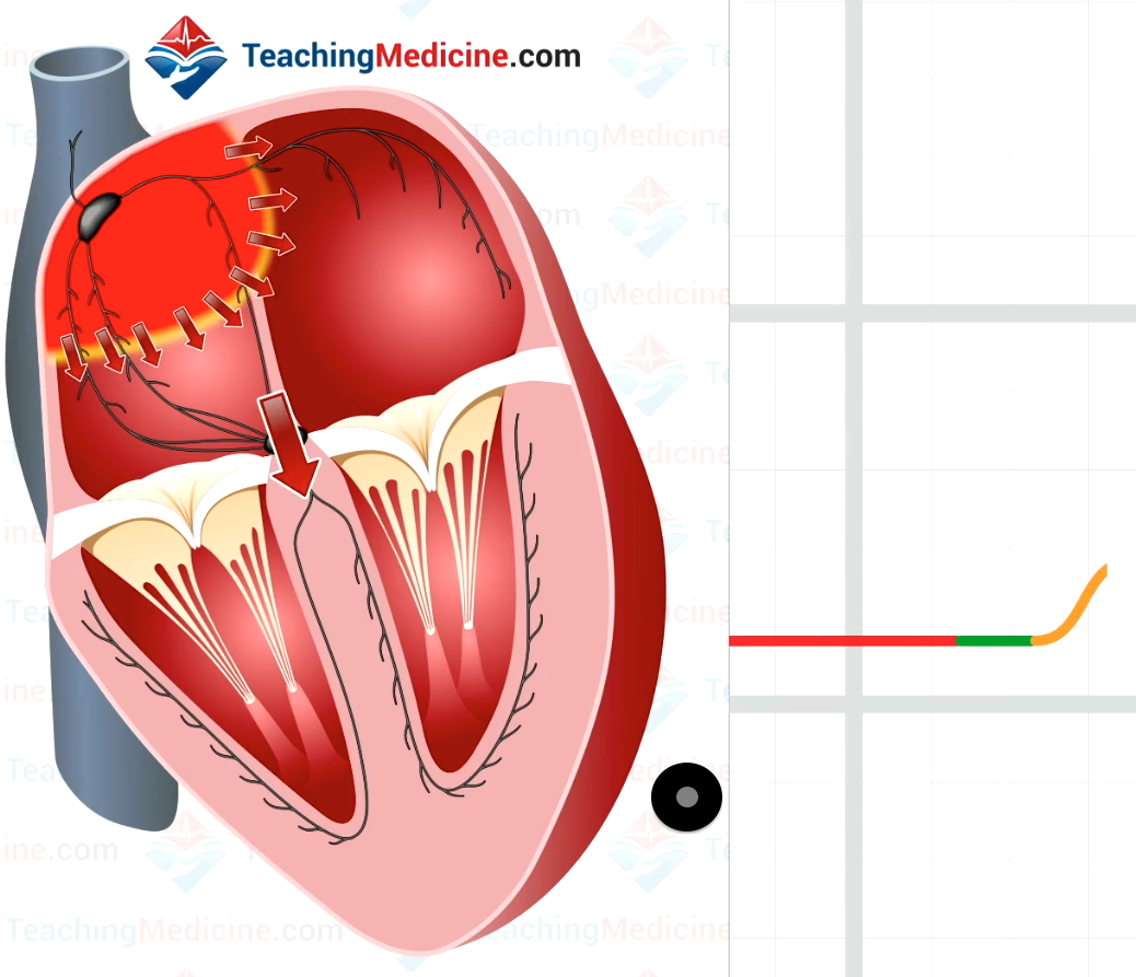 Atrial depolarization creates upward deflection which is the P wave