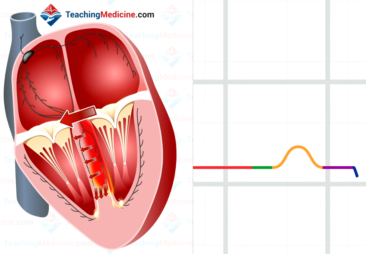 Septal depolarization causes depolarization toward the RV, which is slightly away from lead II positive electrode, so a downward deflection occurs