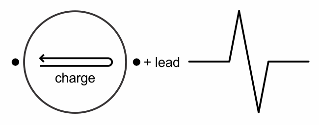 Initial upward deflection followed by downward deflection