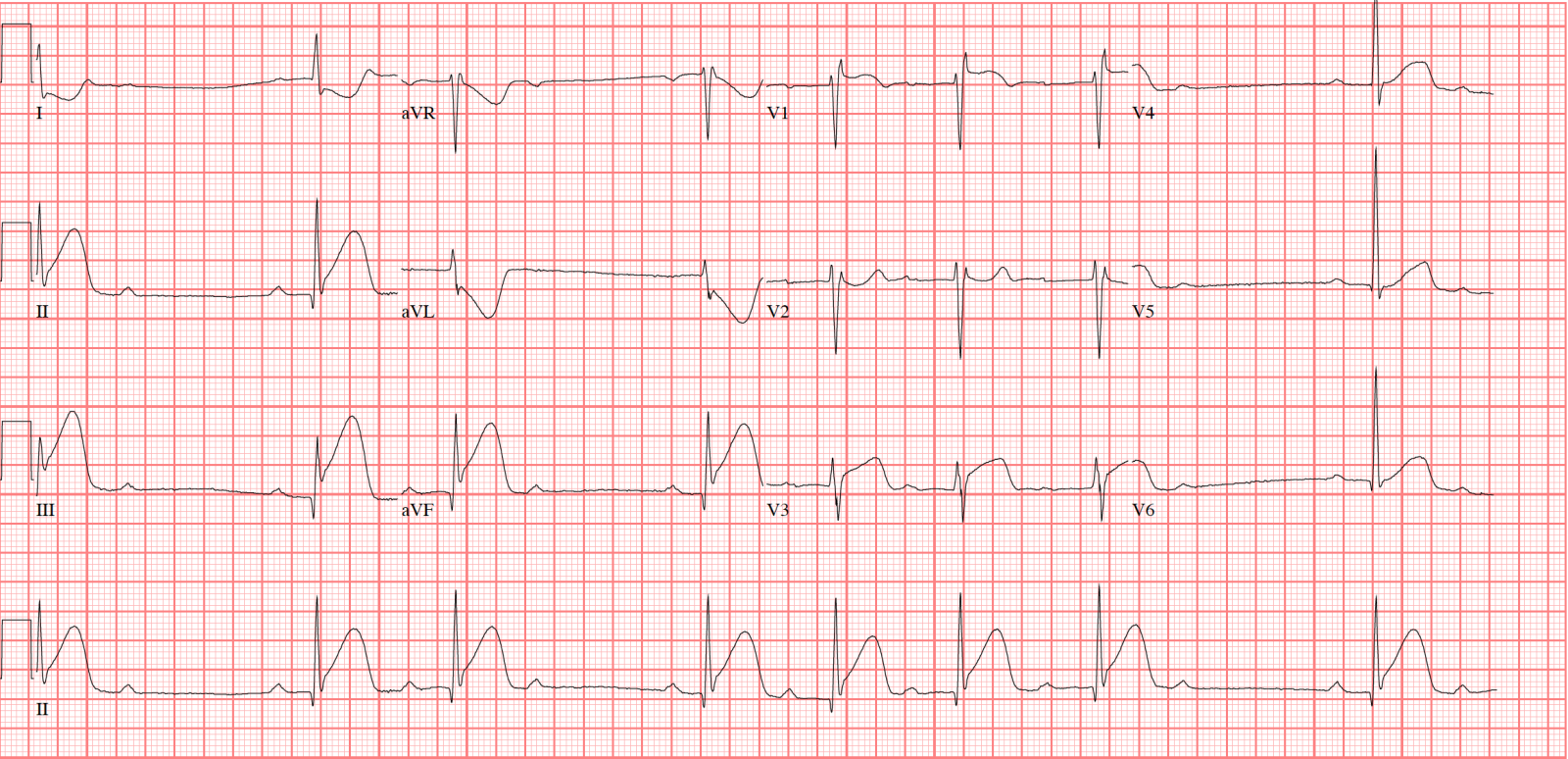 Heart Block Second Degree Type 1