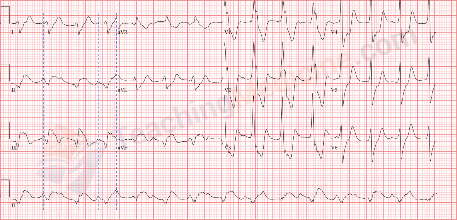 Teaching Medicine Tutorial Rhythm Diagnostic Criteria