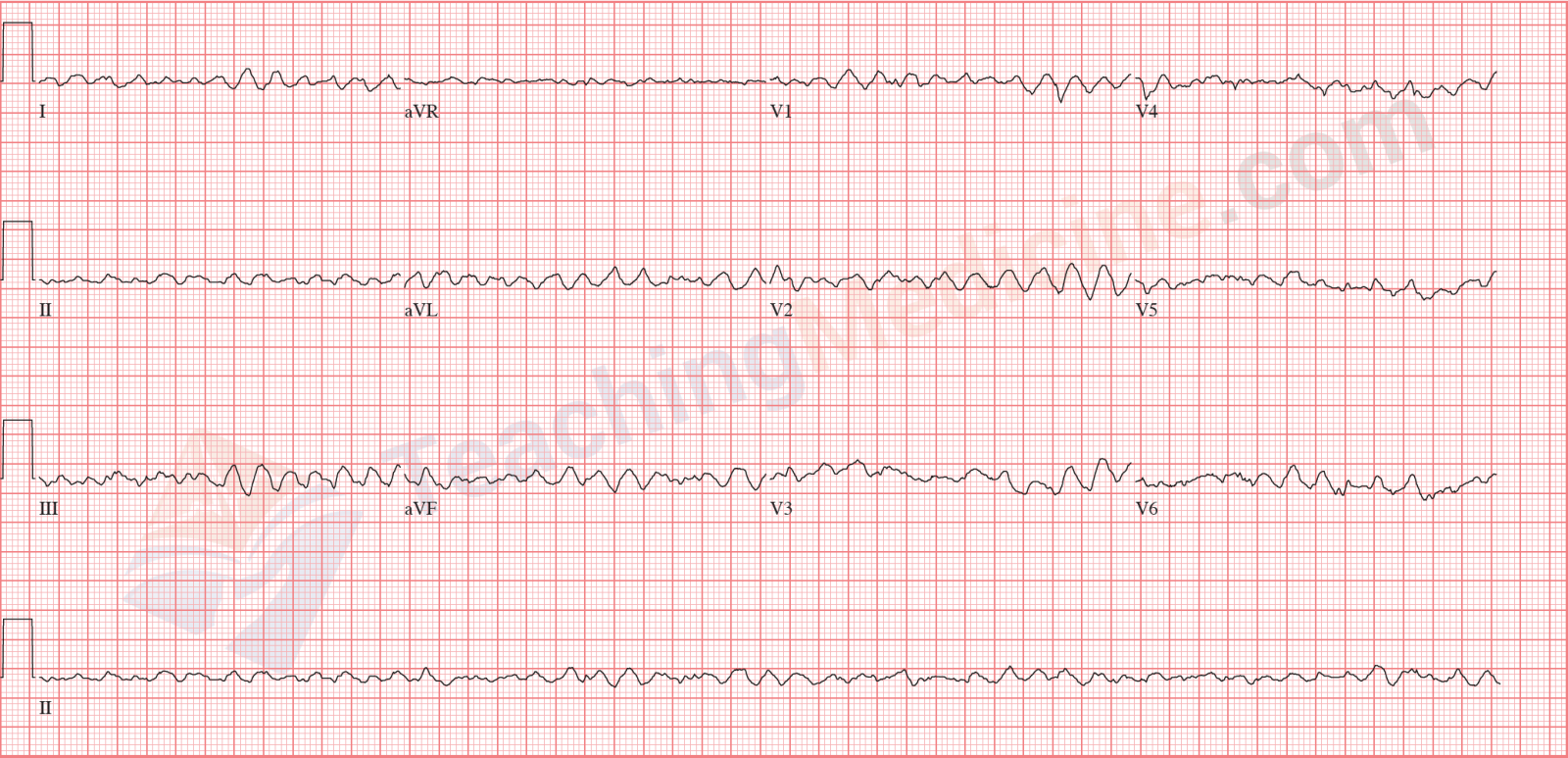 ventricular fibrillation