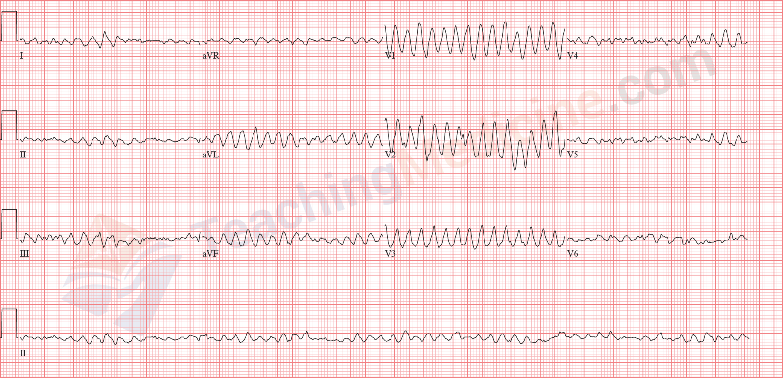 ventricular fibrillation