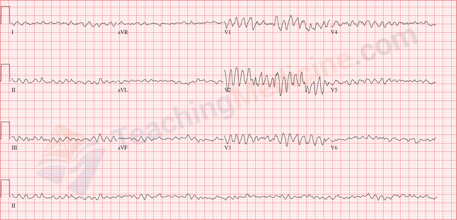 ventricular fibrillation