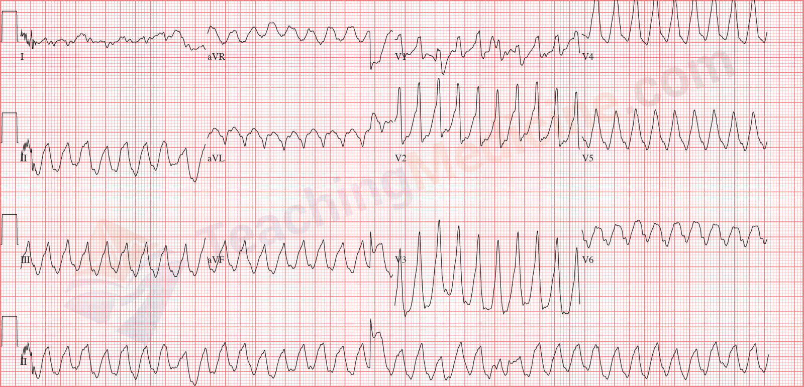 monomorphic ventricular tachycardia also known as VT