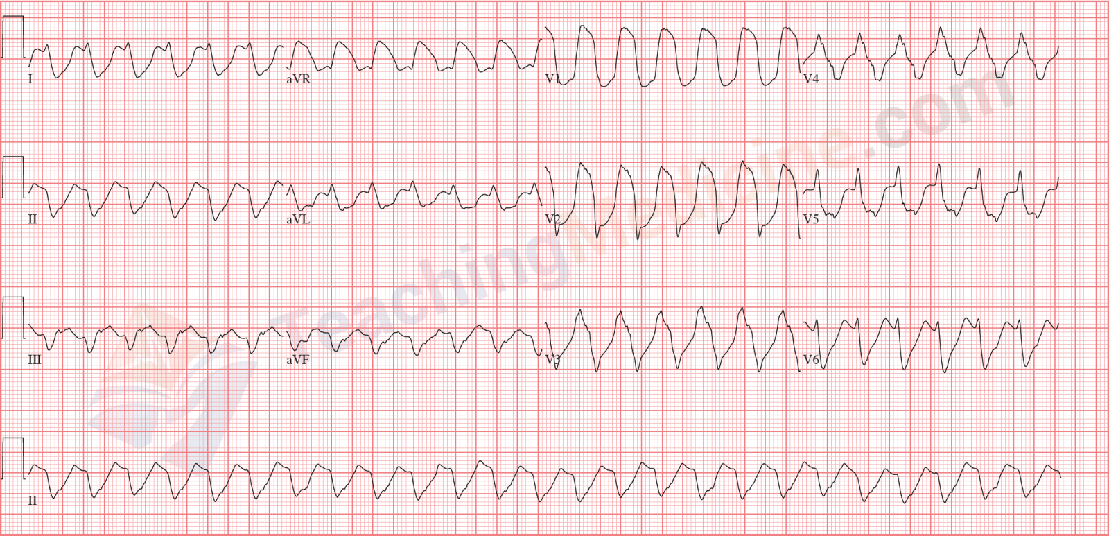 monomorphic ventricular tachycardia also known as VT