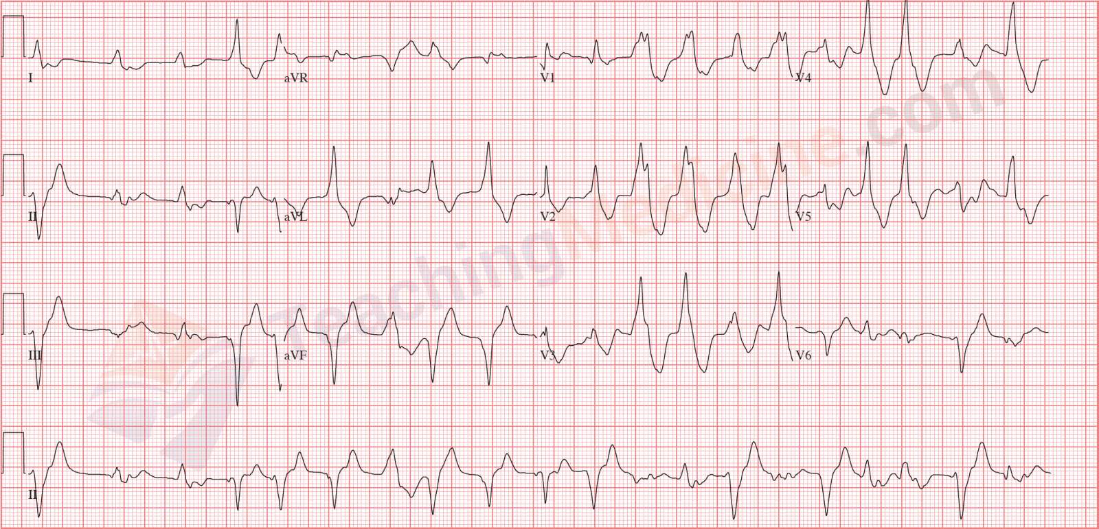 polymorphic ventricular tachycardia also known as VT