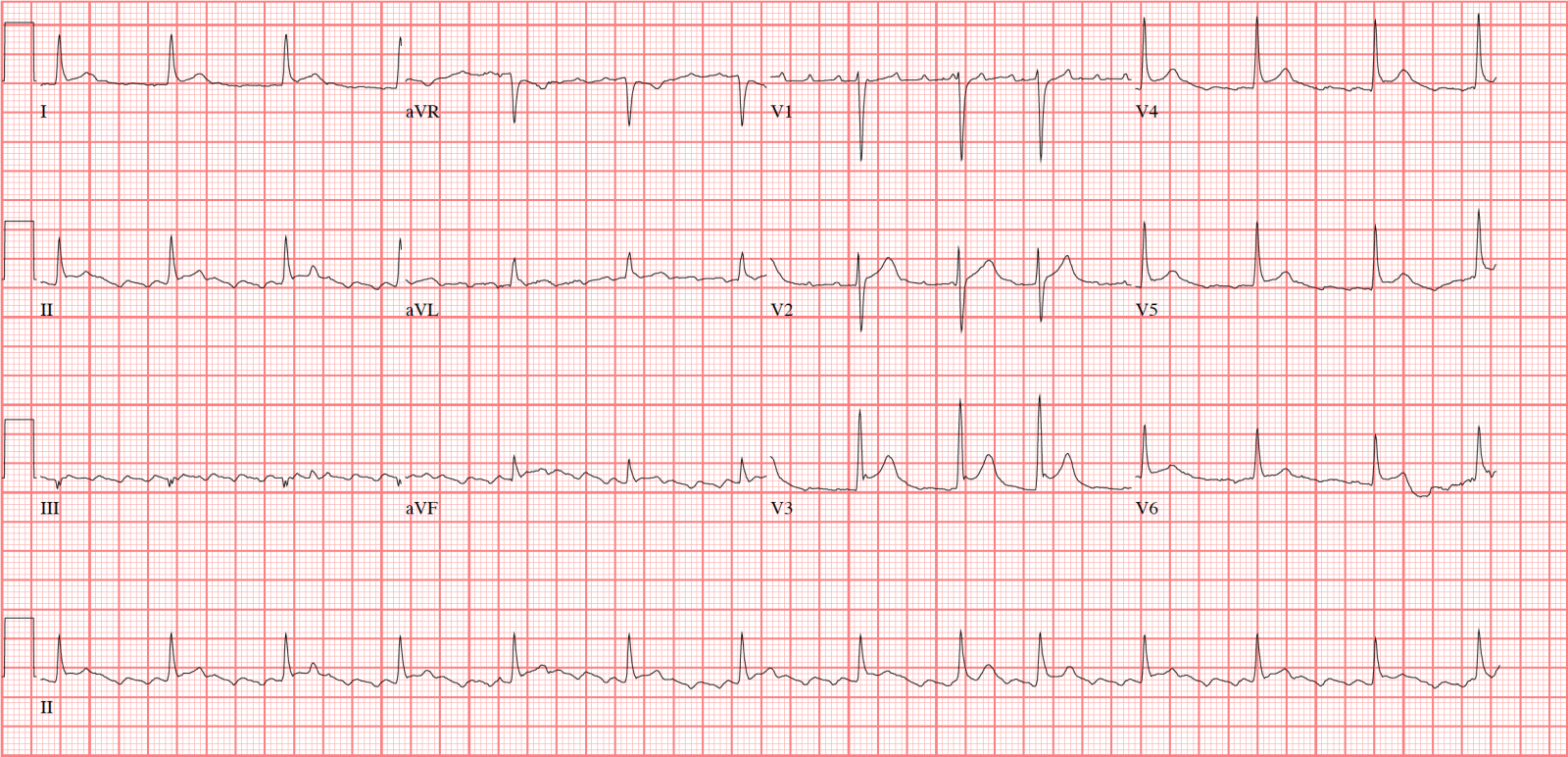 atrial flutter