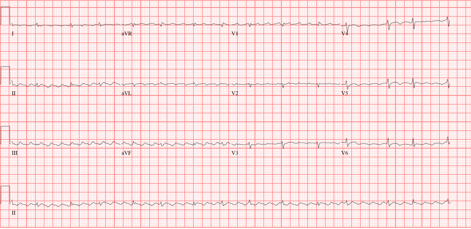 atrial flutter