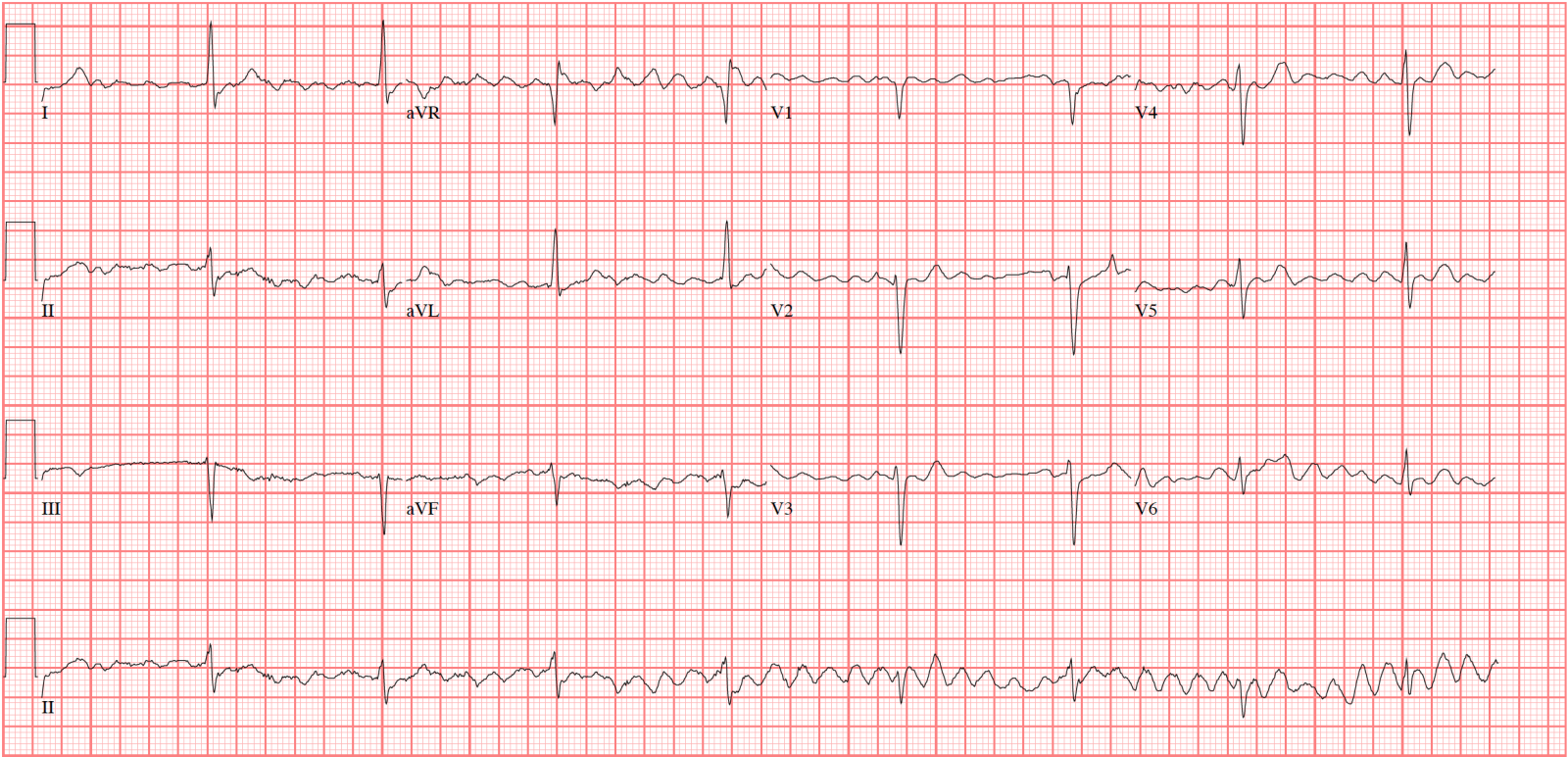 atrial flutter