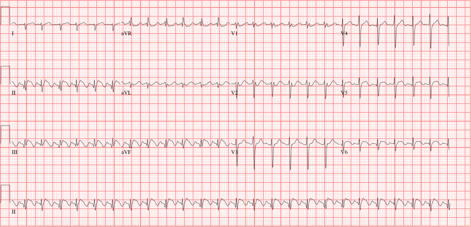 atrial flutter