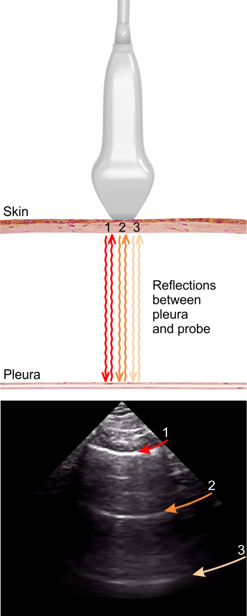 A lines on ultrasound