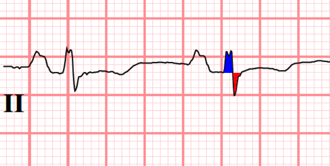 ECG axis determination