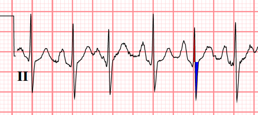 ECG axis determination