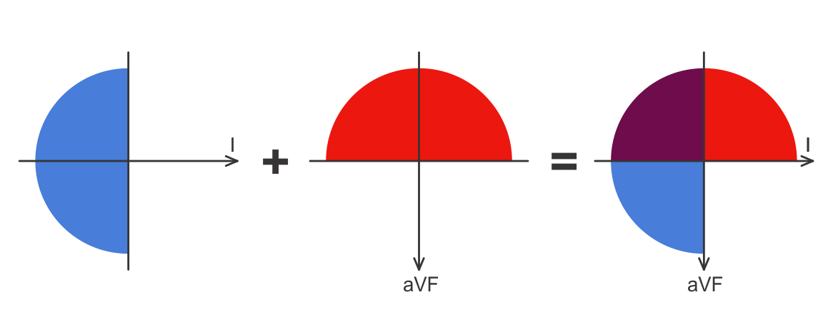 extreme RAD ECG axis