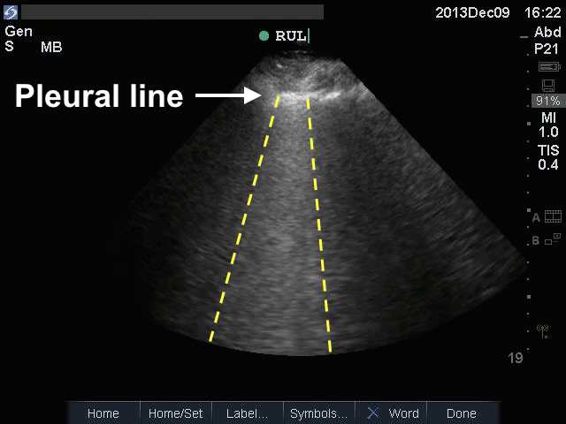 B lines on ultrasound