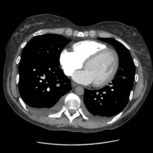 understanding LBBB