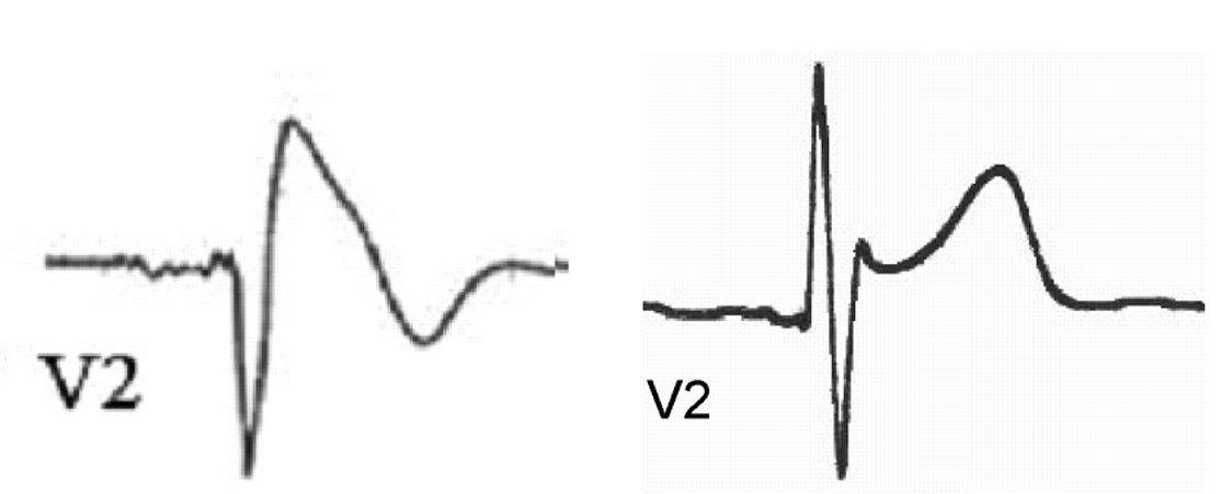 coved ST segment