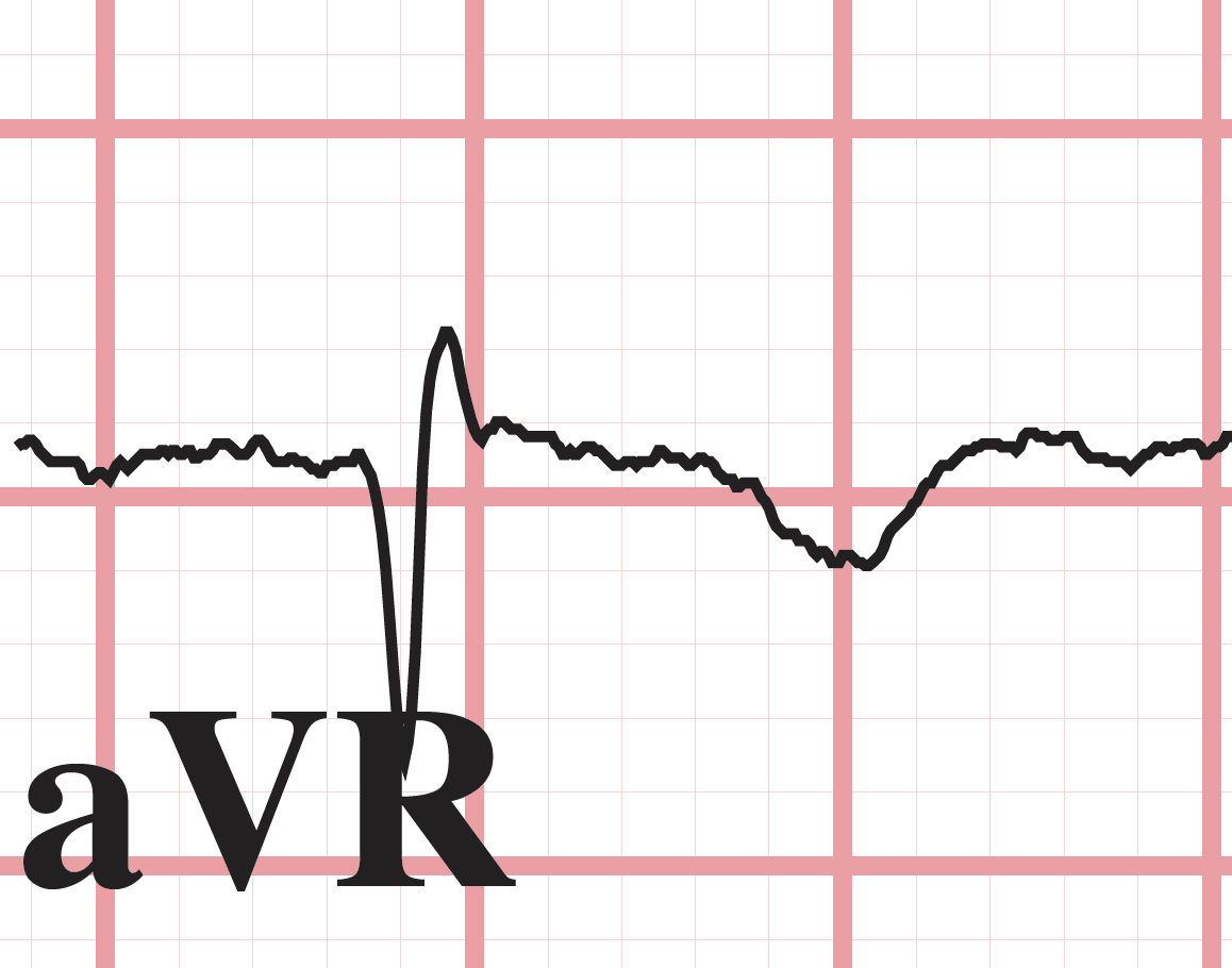 concordant T wave