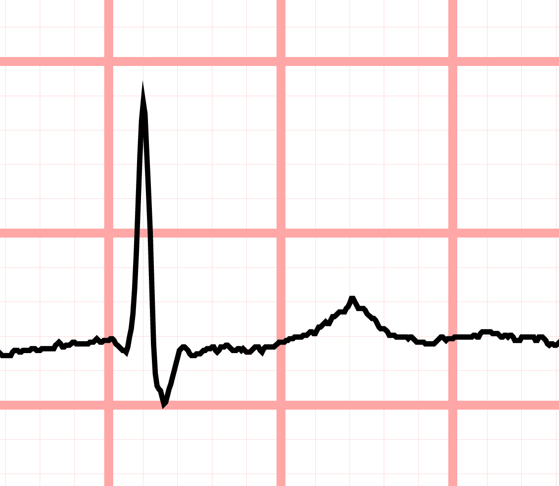 concordant T wave