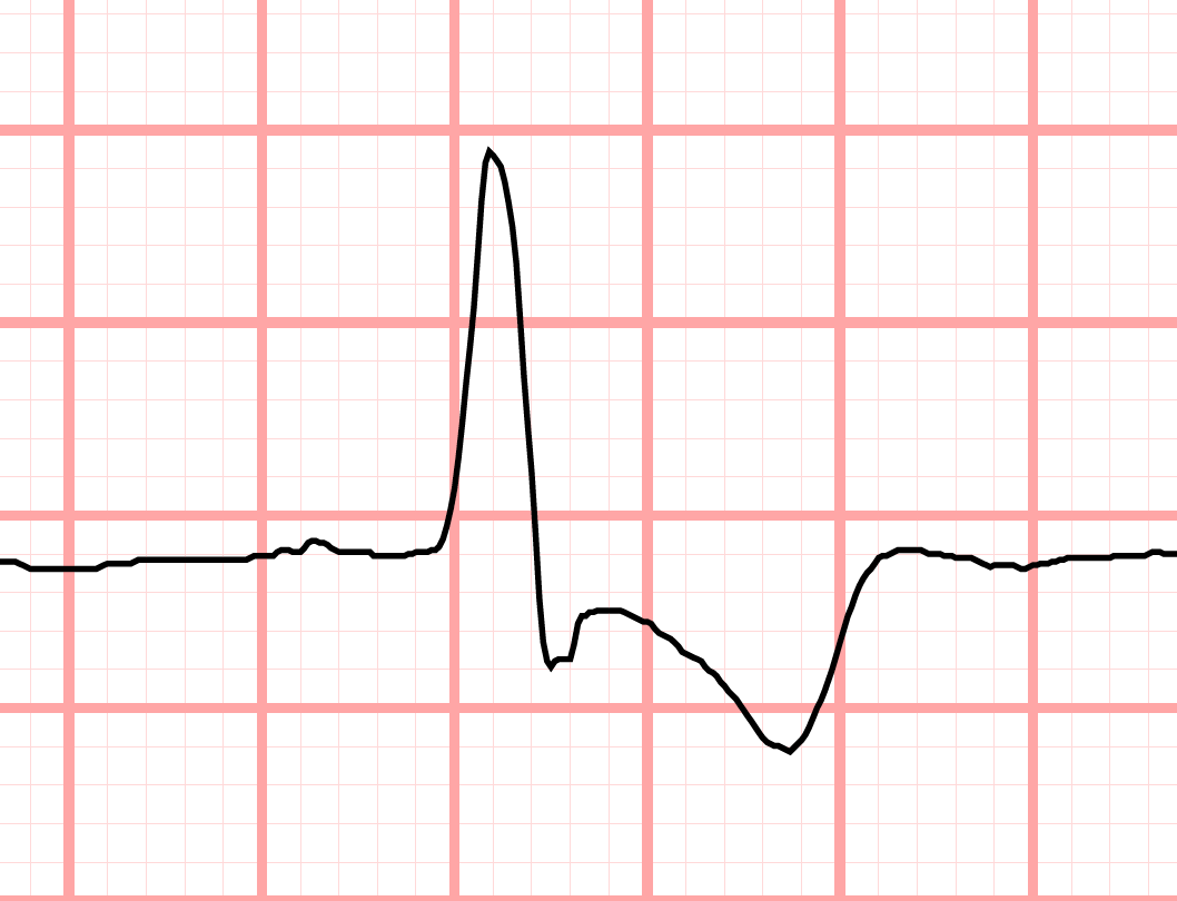 discordant T wave