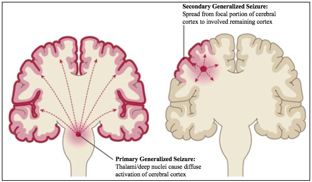 generalized epilepsy generalized epilepsy EEG vs normal EEG generalized epilepsy generalized epilepsy EEG vs normal EEG